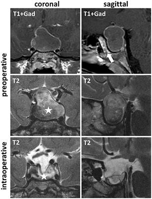 Rathke's Cleft Cyst as Origin of a Pediatric Papillary Craniopharyngioma